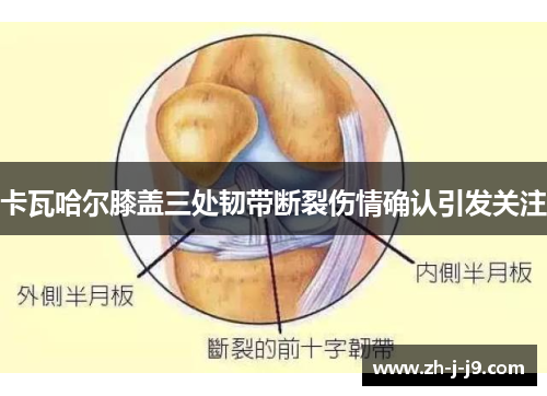卡瓦哈尔膝盖三处韧带断裂伤情确认引发关注